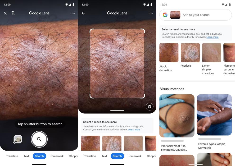 Google Lens ganha função para identificar problemas de pele